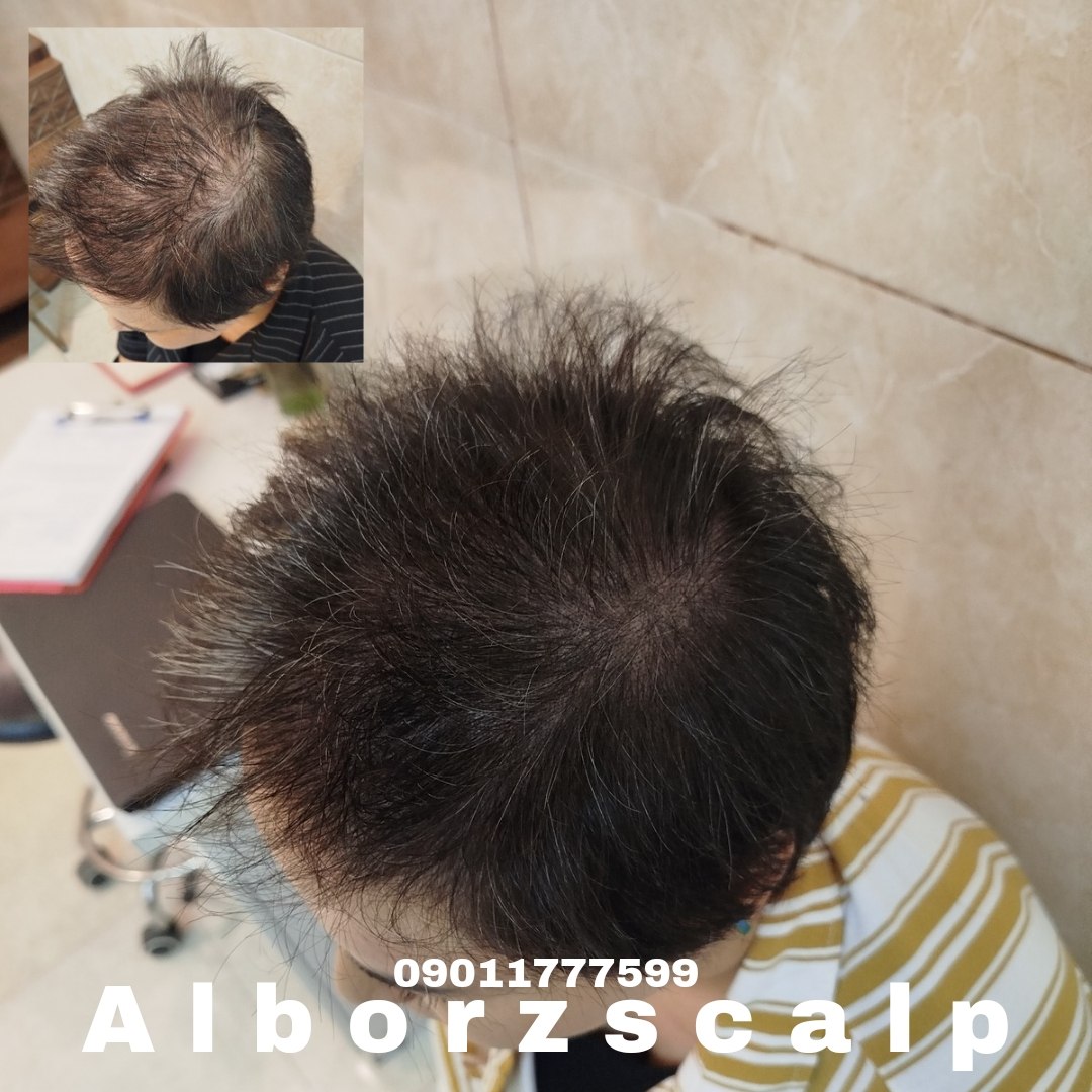 اسکالپ پوششی